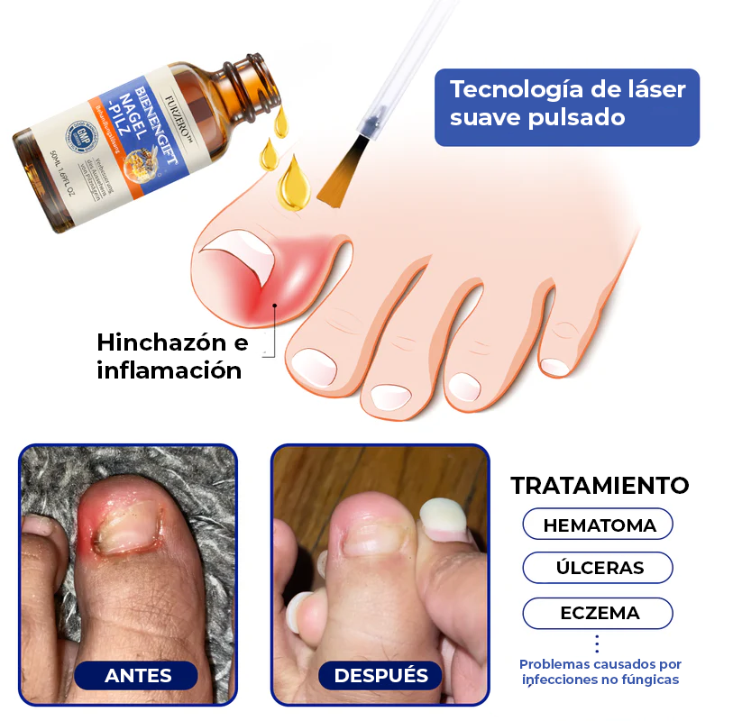 NailGift™ | Elimina el 97% de las infecciones de uñas en solo 10 días